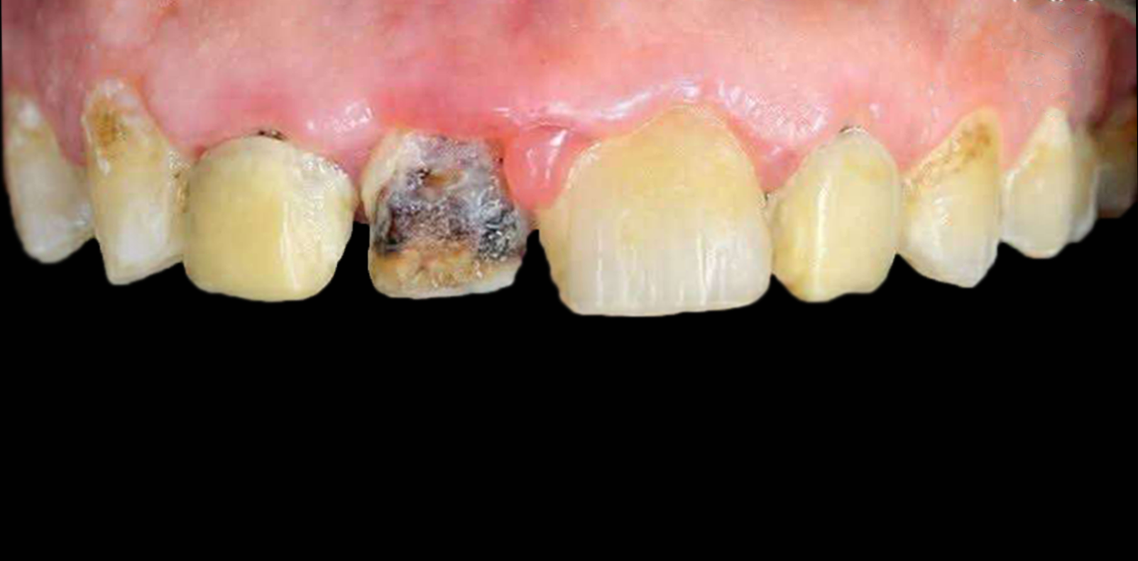 قبل — تركيبات زيركون لتجميل الابتسامة
